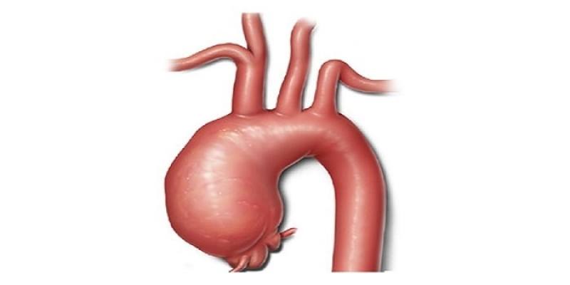 aort anevrizması ve yüksek tansiyon)