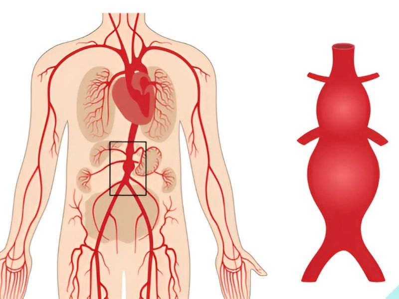 aort-anevrizmasi-ile-ilgili-bilinmesi-gerekenler-2